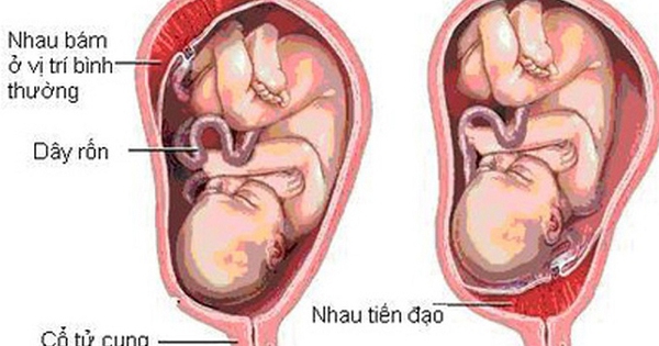 Nhau tiền đạo: Nguyên nhân, triệu chứng, cách điều trị và phòng ngừa