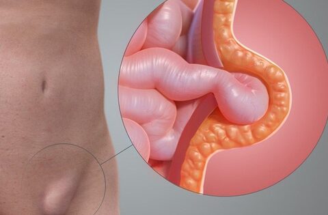 Thoát vị bẹn ở trẻ em có tự khỏi không?