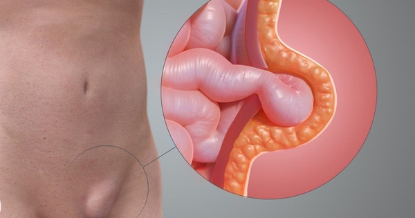 Thoát vị bẹn ở trẻ em có tự khỏi không?