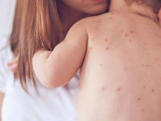 Yêu con - 4 sai lầm khi chăm sóc trẻ sơ sinh nhiều mẹ Việt mắc phải khiến con bị rôm sảy