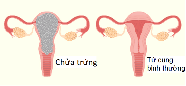 Chửa trứng có nguy hiểm không?- Ảnh 1.