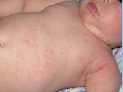 Yêu con - Trẻ bị rôm sảy cần phải làm thế nào?