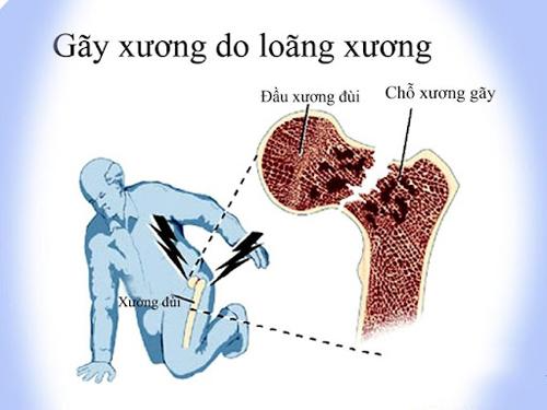 Bật mí bí quyết chắc khỏe xương cho cả nhà- Ảnh 2.