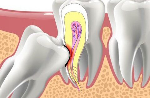 Răng mọc lạc chỗ có dấu hiệu gì?