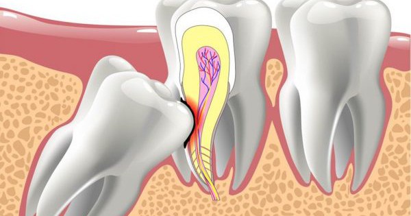 Răng mọc lạc chỗ có dấu hiệu gì?