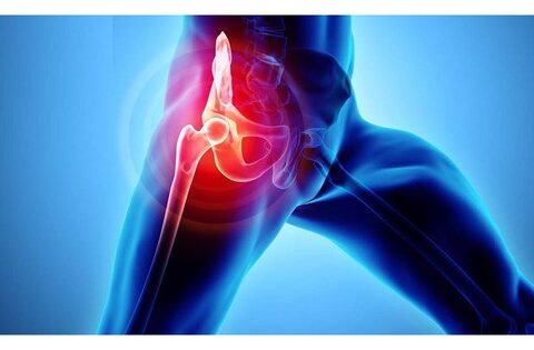 Trẻ sưng đau vùng háng, khó ngồi, cảnh giác với  viêm khớp háng