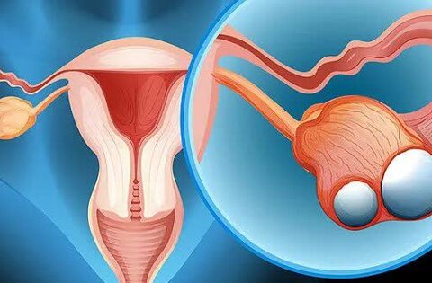 Bác sĩ khuyến nghị 5 điều quan trọng về ung thư buồng trứng