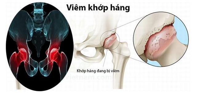 Trẻ sưng đau vùng háng, khó ngồi, cảnh giác với  viêm khớp háng - Ảnh 1.