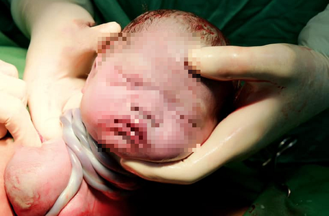 Thai nhi bị dây rốn quấn cổ có đẻ thường được không?