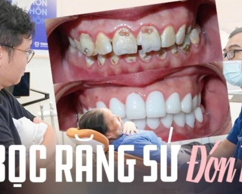 Làm răng sứ đón Tết lúc này có phù hợp? BS chỉ rõ ưu – nhược điểm, giá từng loại tham khảo trước khi làm