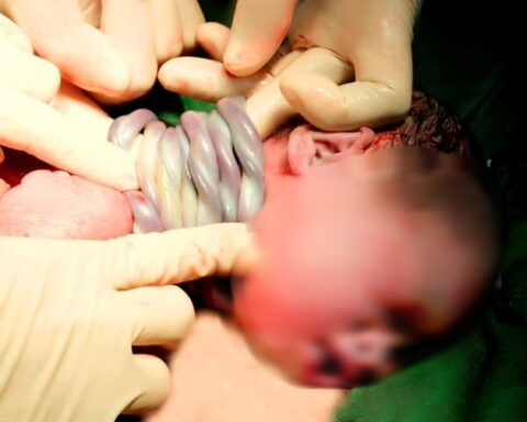 Hy hữu: Bé gái “vượt ngàn chông gai” chào đời khỏe mạnh với 9 vòng dây rốn quấn cổ