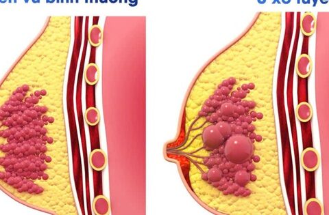 U xơ tuyến vú có dẫn đến ung thư vú không?