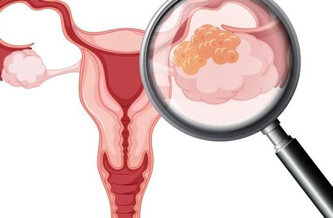 Giai đoạn sớm của ung thư buồng trứng và quá trình tiến triển