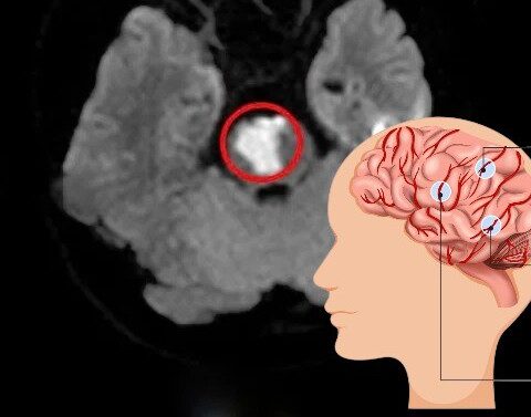 Hiếm gặp: Thiếu niên 17 tuổi bị đột quỵ, dấu hiệu ban đầu dễ nhầm lẫn nên bị bỏ qua