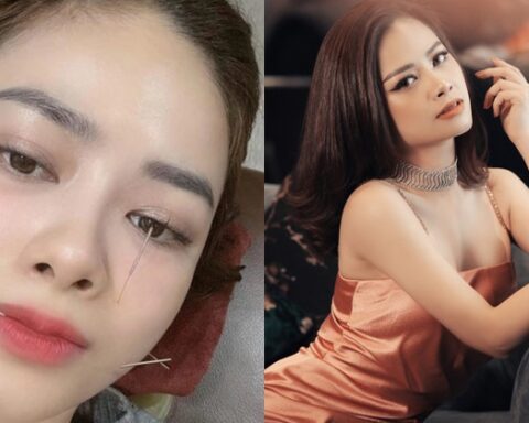 Dương Hoàng Yến môi méo, sưng mặt vì liệt dây thần kinh số 7: Ai cũng có thể mắc nếu thuộc 5 nhóm người này