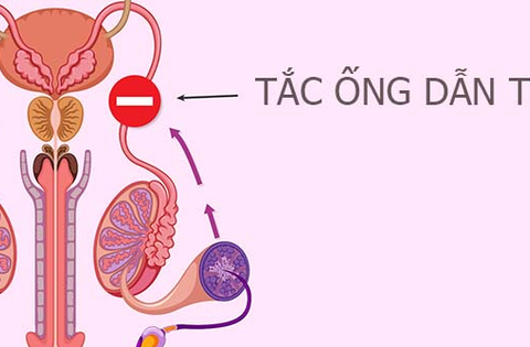 Tắc ống dẫn tinh: Nguyên nhân, triệu chứng, phương án điều trị