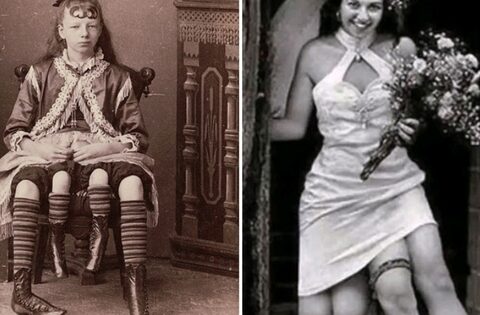 Cô gái có 4 chân, sở hữu cơ thể đặc biệt: 2 “vùng kín”, 2 xương chậu, sống cuộc đời trọn vẹn