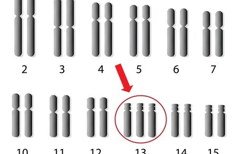 6 câu hỏi thường gặp về hội chứng Patau