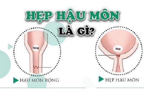 Câu hỏi thường gặp liên quan đến hẹp hậu môn ở trẻ em