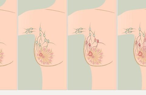 Các giai đoạn ung thư vú