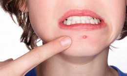 Điều trị mụn như thế nào là đúng cách và bao lâu sẽ có hiệu quả?