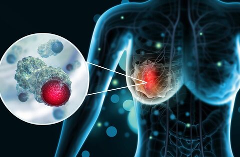 12 kiểu phụ nữ dễ bị ung thư vú