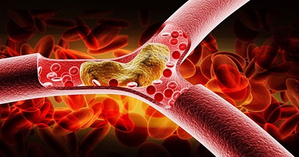 Người phụ nữ 54 tuổi tử vong vì mỡ máu cao: Bác sĩ chỉ mặt 4 “sát thủ trên bàn ăn” cần tránh ngay!