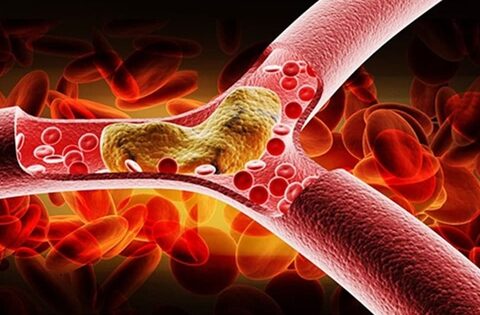 Người phụ nữ 54 tuổi tử vong vì mỡ máu cao: Bác sĩ chỉ mặt 4 “sát thủ trên bàn ăn” cần tránh ngay!