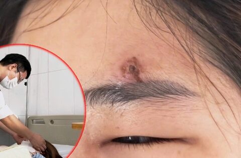 Tự nặn mụn ở trán, người phụ nữ U40 phải trả giá đắt