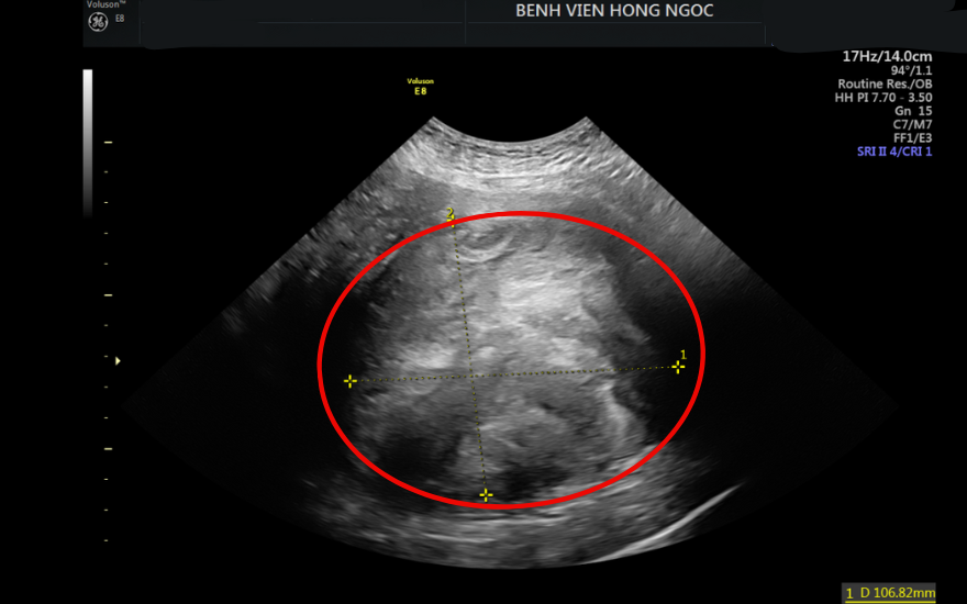 Người phụ nữ hơn 1 thập kỷ “sống chung” với u xơ tử cung nặng gần 1.5kg- Ảnh 2. Người phụ nữ hơn 1 thập kỷ “sống chung” với u xơ tử cung nặng gần 1.5kg- Ảnh 2.