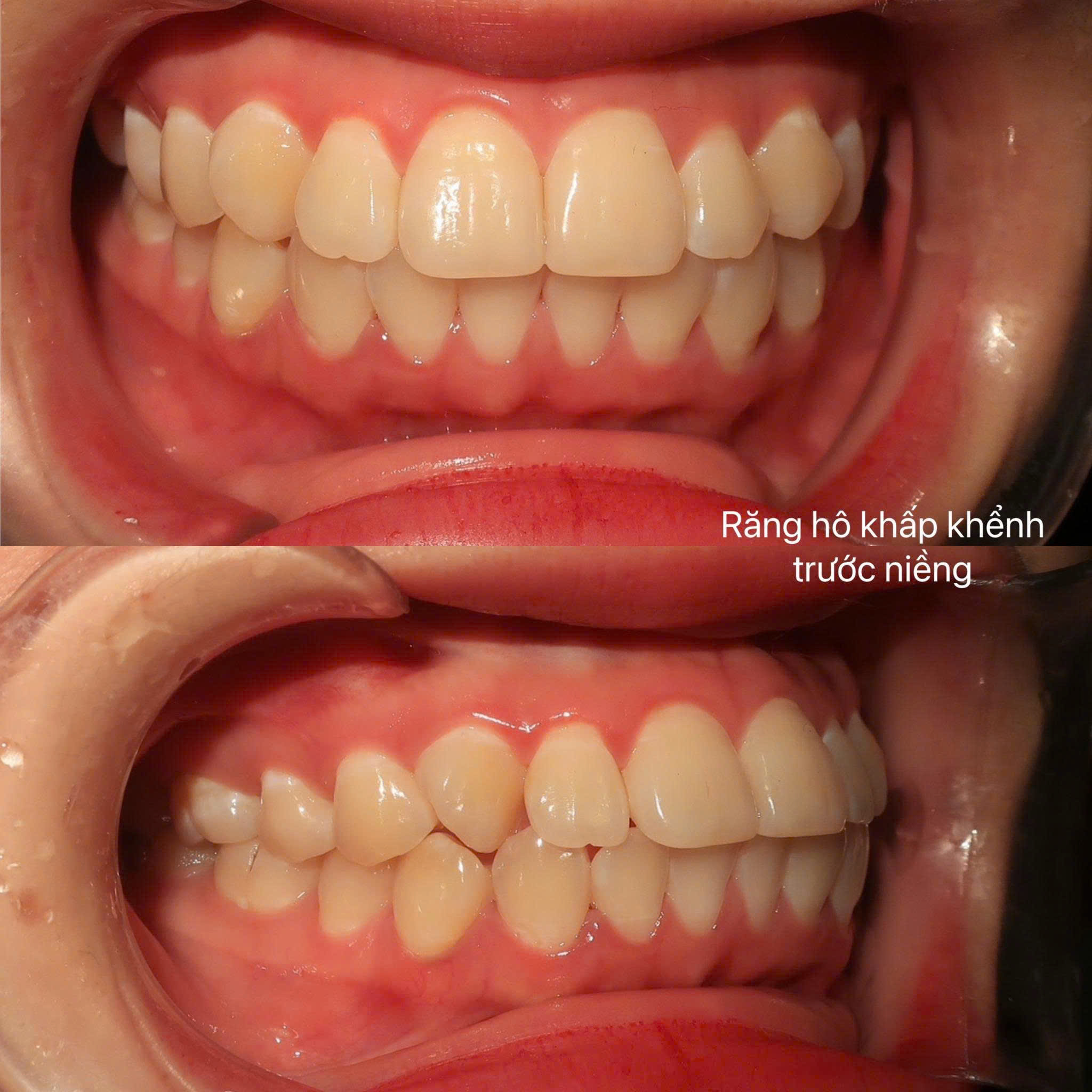 Niềng răng sau tuổi 30: Bác sĩ nói trễ nhưng không hề muộn để đẹp và khỏe- Ảnh 3.