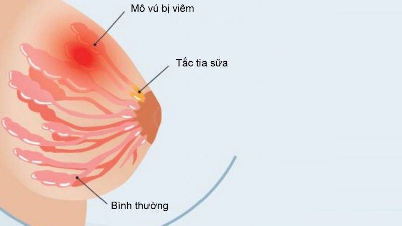 Mẹ bị viêm tuyến vú có cho con bú được không?- Ảnh 1. Mẹ bị viêm tuyến vú có cho con bú được không?- Ảnh 1.