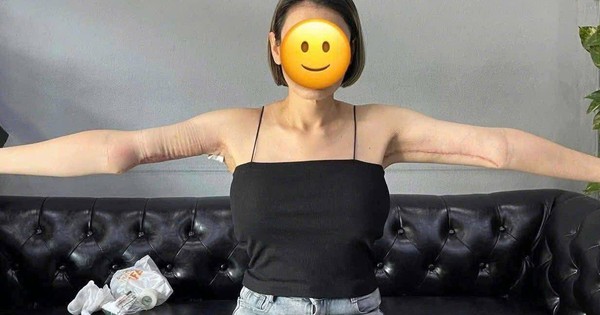 Hình ảnh cánh tay sau hút mỡ khiến ai cũng “bàng hoàng”: Sai 1 ly đi cả sức khỏe!