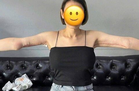 Hình ảnh cánh tay sau hút mỡ khiến ai cũng “bàng hoàng”: Sai 1 ly đi cả sức khỏe!
