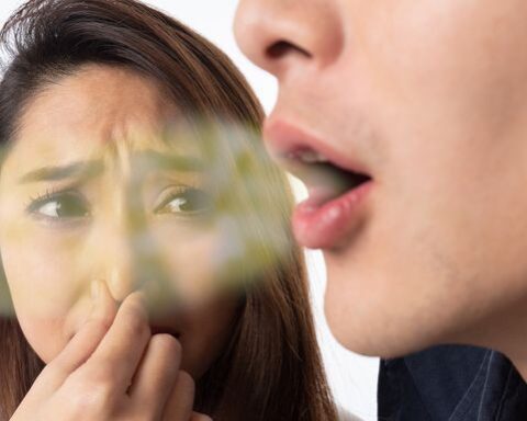 Lý do đặc biệt khiến người niềng răng dễ hôi miệng