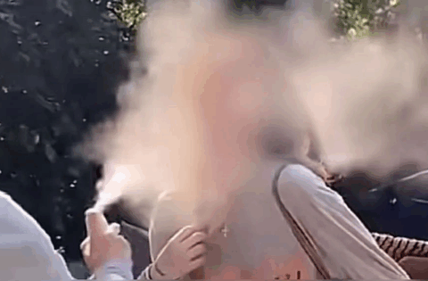 Người phụ nữ bị “phổi trắng xóa” chỉ đúng 1 phút sau khi xịt kem chống nắng