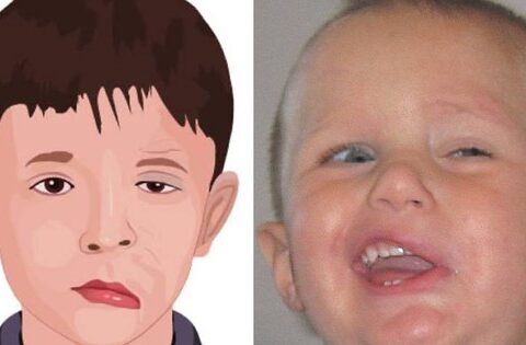 Cách xoa bóp, tập luyện cho trẻ bị liệt dây thần kinh số 7 ngoại biên tại nhà