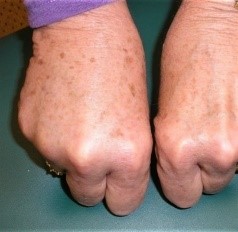 Cách kiểm soát tình trạng phù bạch huyết ở bệnh nhân ung thư vú- Ảnh 2. Close-up of a person's feet Description automatically generated with low confidence