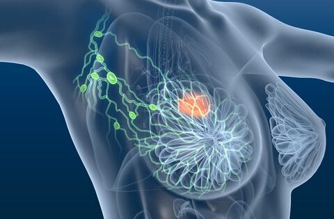 Ung thư vú có phải do gene không?