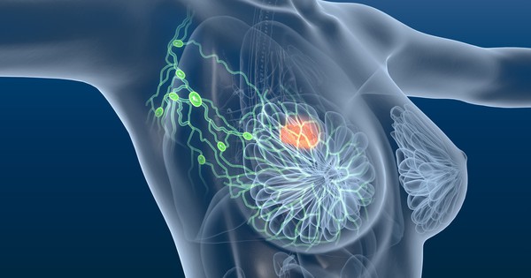 Ung thư vú có phải do gene không?