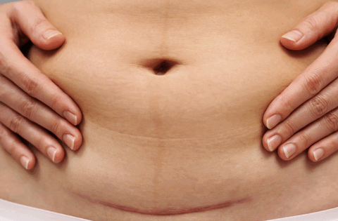 Những vấn đề cần lưu ý sau khi sinh mổ các bà mẹ cần biết