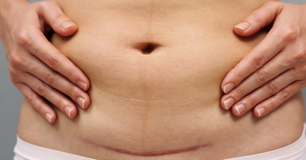 Những vấn đề cần lưu ý sau khi sinh mổ các bà mẹ cần biết