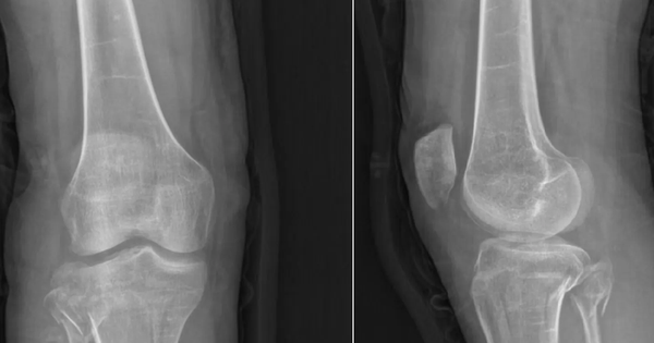 Cô gái 21 tuổi mắc “hội chứng búp bê sứ”