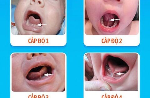 Trẻ bú khó coi chừng mắc dính thắng lưỡi