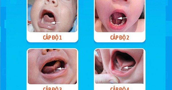 Trẻ bú khó coi chừng mắc dính thắng lưỡi