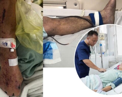 Người đàn ông ở Hưng Yên nguy kịch, tím toàn thân sau chế biến thịt lợn sống, bác sĩ khuyến cáo 3 không