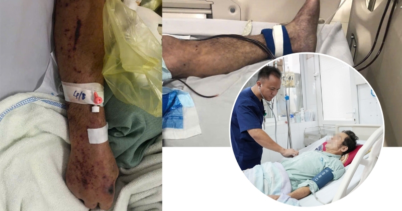 Người đàn ông ở Hưng Yên nguy kịch, tím toàn thân sau chế biến thịt lợn sống, bác sĩ khuyến cáo 3 không