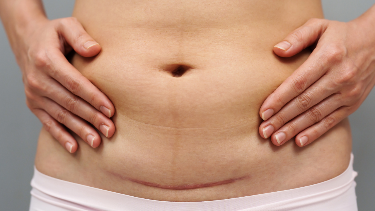 Những vấn đề cần lưu ý sau khi sinh mổ các bà mẹ cần biết- Ảnh 1.