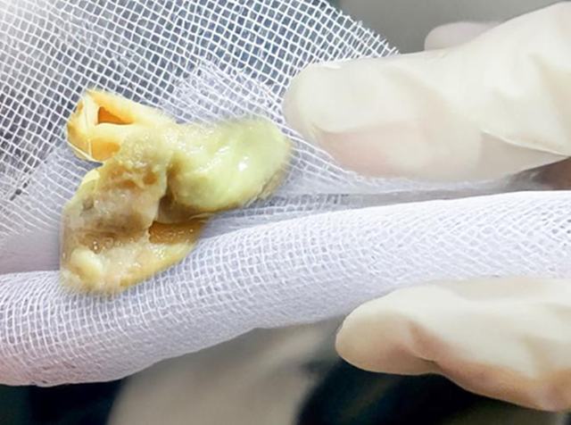 Chảy mũi có mùi hôi sau 5 ngày nâng mũi, người phụ nữ tá hỏa phát hiện Chảy mũi có mùi hôi sau 5 ngày nâng mũi, người phụ nữ tá hỏa phát hiện