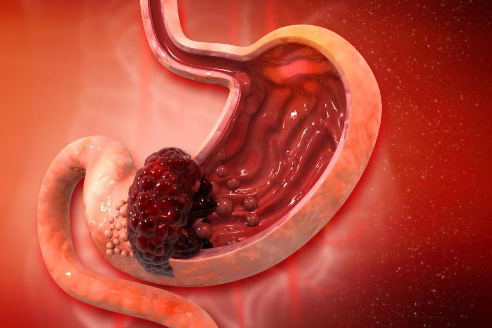 Tại sao ngày càng nhiều người trẻ mắc ung thư dạ dày? Câu trả lời có thể nằm trong thói quen bạn làm mỗi tối!- Ảnh 1.